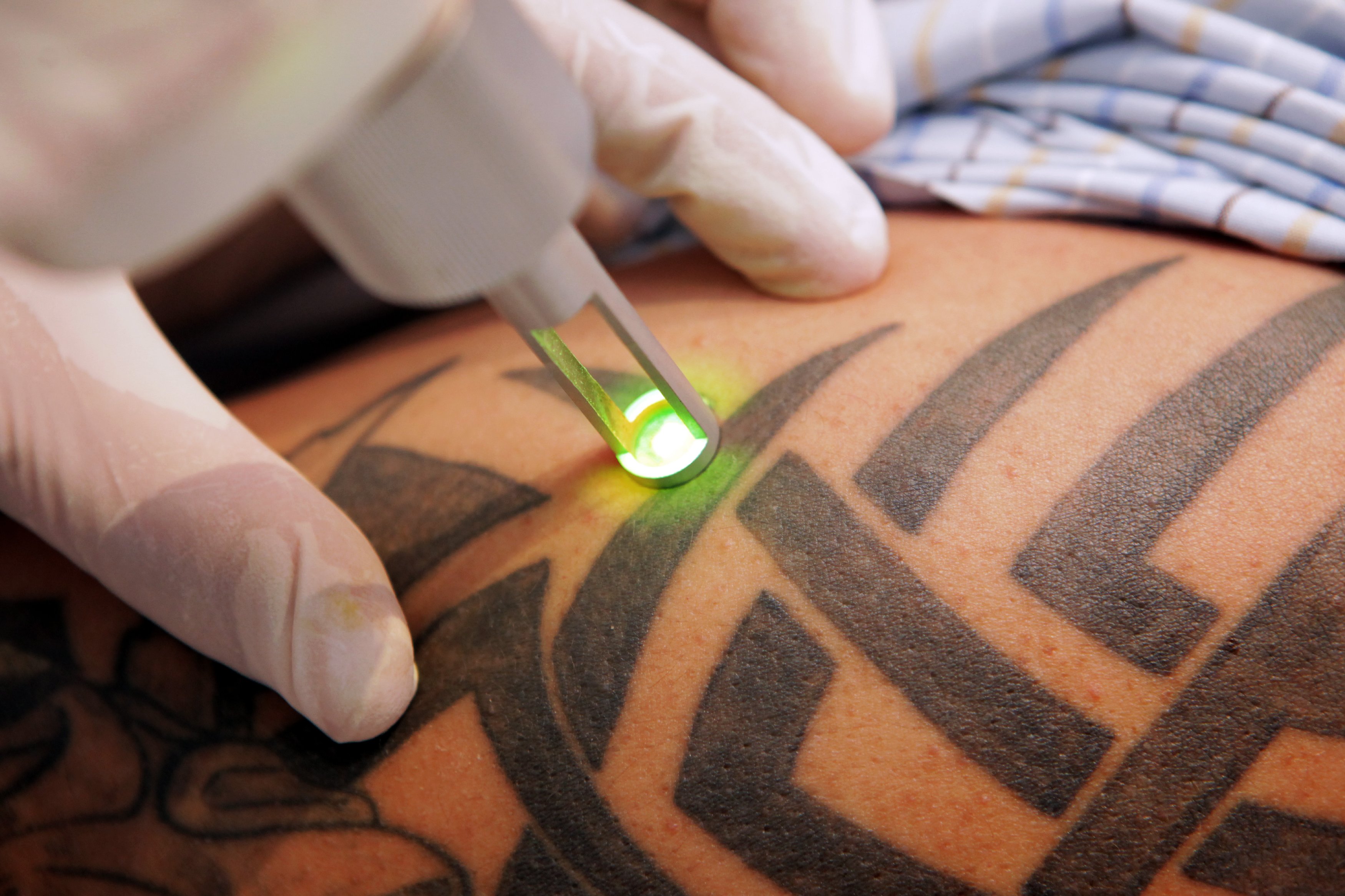 Убрать тату лазером. Лазерное сведение татуировок.